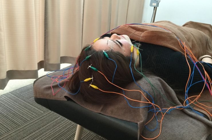 美容鍼　電気を流す美容鍼34本（40分）