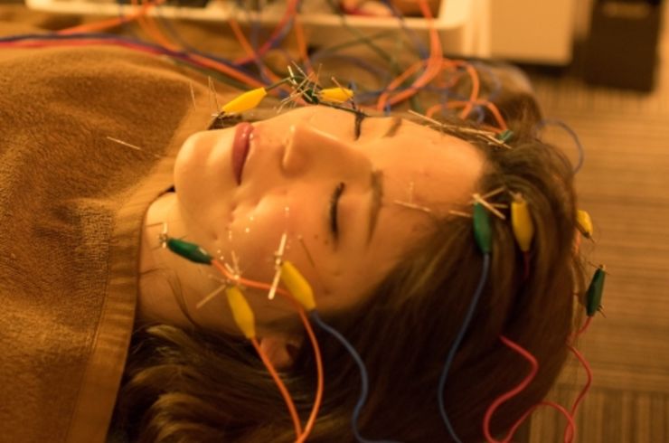 電気を流す美容鍼40本