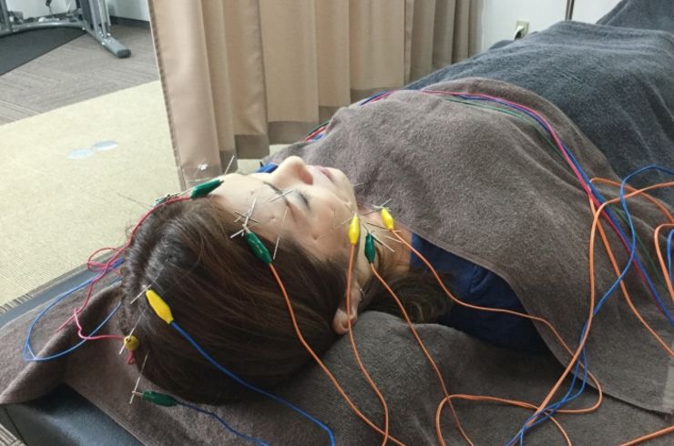 電気を流す美容鍼55本